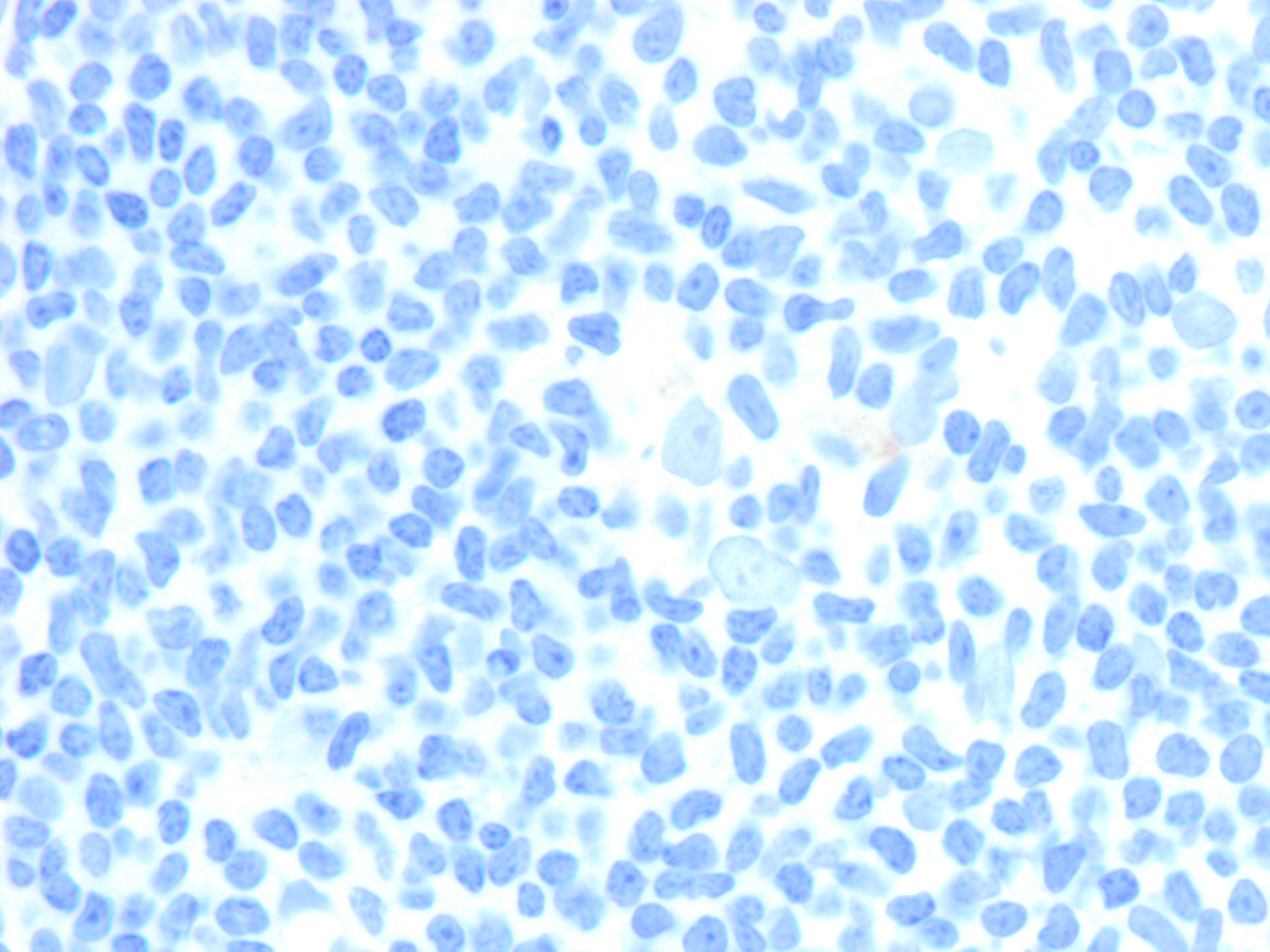Specimen 3, BM core biopsy, CD117 x 200